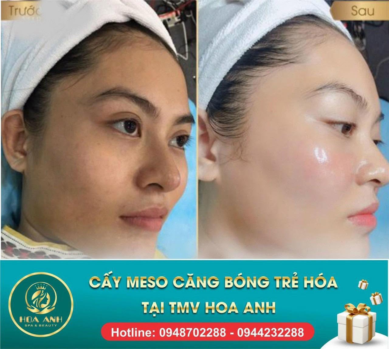 Trước và sau tiêm Meso căng bóng da tại Hoa Anh